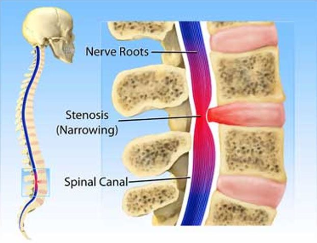 Doctors Gave Up Fixing This 50-Year Old Woman’s Spinal Stenosis, but ...